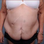 Abdominoplasty Before & After Patient #1876