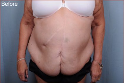 Abdominoplasty Before & After Patient #1876