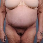 Abdominoplasty Before & After Patient #1876