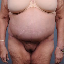 Abdominoplasty Before & After Patient #1876