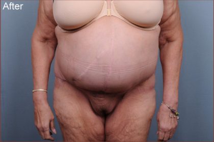 Abdominoplasty Before & After Patient #1876