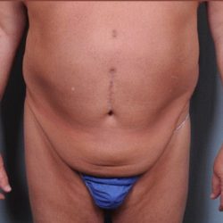 Abdominoplasty Before & After Patient #1875