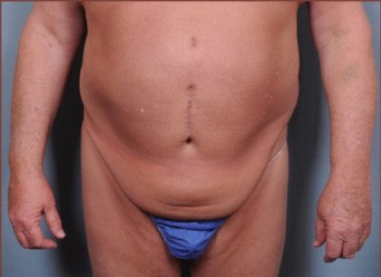 Abdominoplasty Before & After Patient #1875