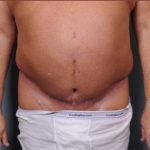 Abdominoplasty Before & After Patient #1875