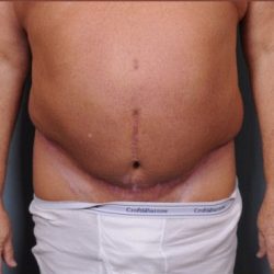 Abdominoplasty Before & After Patient #1875