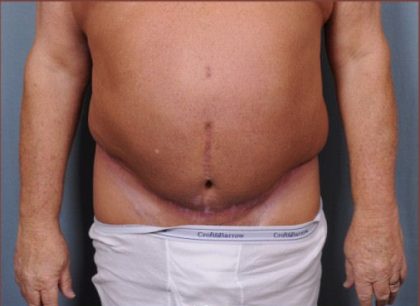 Abdominoplasty Before & After Patient #1875