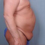 Abdominoplasty Before & After Patient #1875