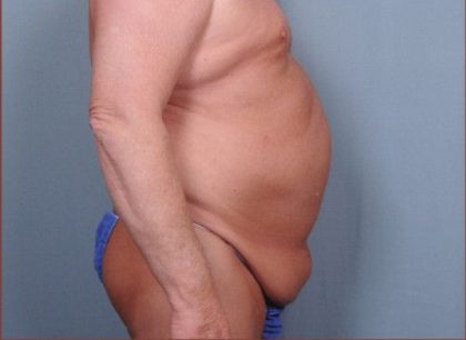 Abdominoplasty Before & After Patient #1875