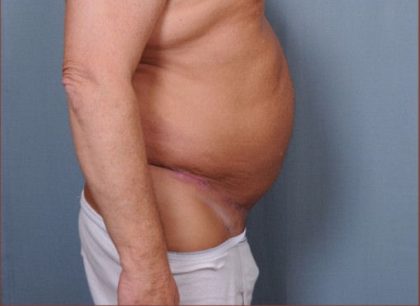 Abdominoplasty Before & After Patient #1875