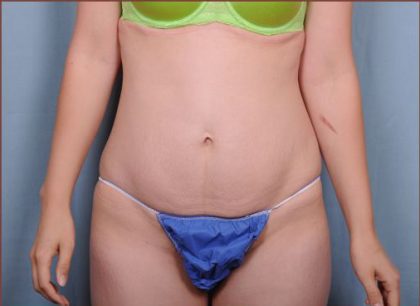 Abdominoplasty Before & After Patient #1874