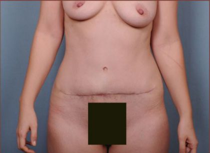 Abdominoplasty Before & After Patient #1874