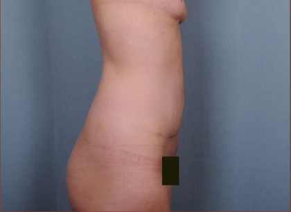 Abdominoplasty Before & After Patient #1874