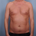 Liposuction Before & After Patient #1873