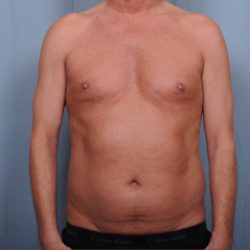 Liposuction Before & After Patient #1873