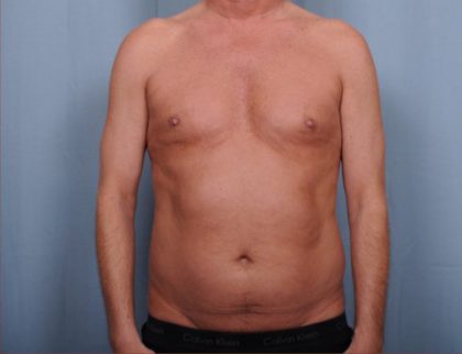 Liposuction Before & After Patient #1873