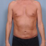 Liposuction Before & After Patient #1873