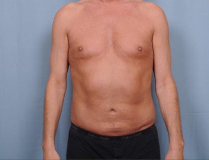 Liposuction Before & After Patient #1873