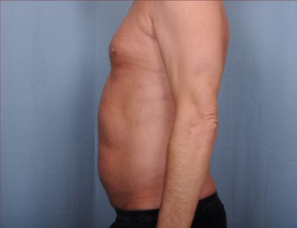 Liposuction Before & After Patient #1873