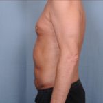 Liposuction Before & After Patient #1873