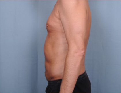 Liposuction Before & After Patient #1873