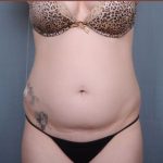 Liposuction Before & After Patient #1872