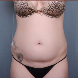 Liposuction Before & After Patient #1872