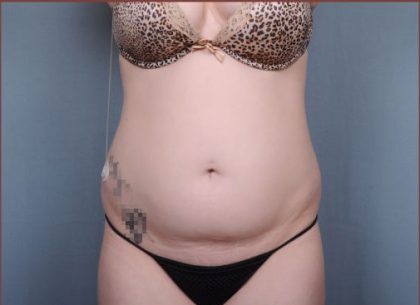 Liposuction Before & After Patient #1872