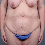Abdominoplasty Before & After Patient #1880