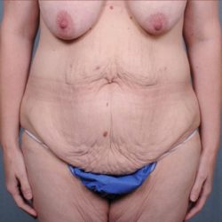 Abdominoplasty Before & After Patient #1880