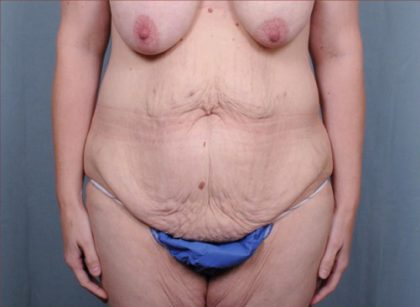 Abdominoplasty Before & After Patient #1880