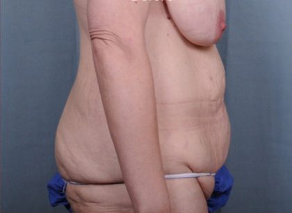 Abdominoplasty Before & After Patient #1880