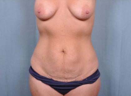 Abdominoplasty Before & After Patient #1878