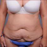 Abdominoplasty Before & After Patient #1891
