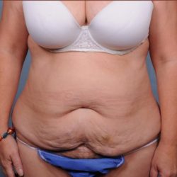 Abdominoplasty Before & After Patient #1891