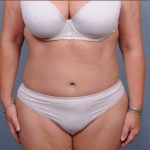 Abdominoplasty Before & After Patient #1891