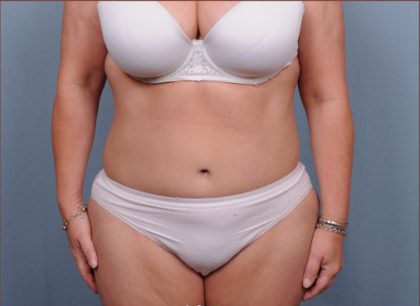 Abdominoplasty Before & After Patient #1891