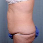 Abdominoplasty Before & After Patient #1891