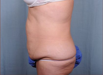 Abdominoplasty Before & After Patient #1891