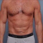 Abdominoplasty Before & After Patient #1889