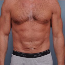 Abdominoplasty Before & After Patient #1889