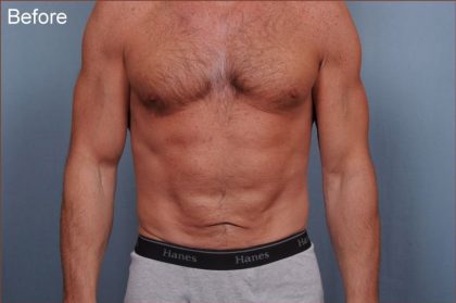 Abdominoplasty Before & After Patient #1889