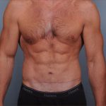 Abdominoplasty Before & After Patient #1889