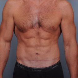 Abdominoplasty Before & After Patient #1889