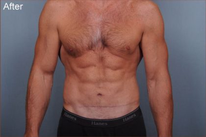Abdominoplasty Before & After Patient #1889