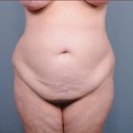 Abdominoplasty Before & After Patient #1887