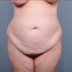 Abdominoplasty Before & After Patient #1887