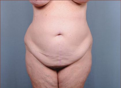 Abdominoplasty Before & After Patient #1887