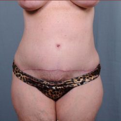 Abdominoplasty Before & After Patient #1887