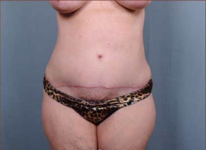 Abdominoplasty Before & After Patient #1887