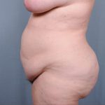 Abdominoplasty Before & After Patient #1887